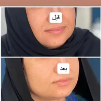 هایفوتراپی14بعدی برای نخستین بار در غرب کشور|خدمات آرایشگری و زیبایی|خرم‌آباد, |دیوار