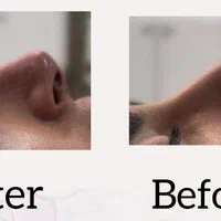 تزریق فیلر بوتاکس و لیفت افتادگی صورت و چشم|خدمات آرایشگری و زیبایی|شیراز, عفیف‌آباد|دیوار