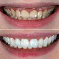 دندانپزشکی زیبایی روکش فوری معاینه رایگان