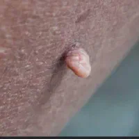 بهبود و رفع دائم ویروس