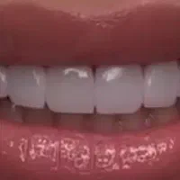 کاشت پرکردن ترمیم رفع پوسیدگی کامپوزیت مدل|خدمات آرایشگری و زیبایی|اهواز, کیانپارس |دیوار
