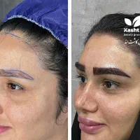 کاشت شقیقه روش بلند کاشت ابرو مو بلفارو غبغب بوکال