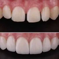 جشنواره دندانپزشکی اقساط ایمپلنت عصبکشی