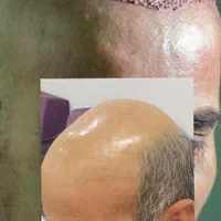 کاشت مو ابرو ریش تارکوب