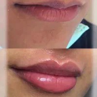 تخفیف عیدانه تزریق ژل،بوتاکس،فشیال.لیزر|خدمات آرایشگری و زیبایی|تهران, نیروی هوایی (پیروزی)|دیوار