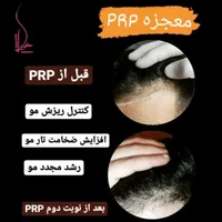 پی ار پی PRP ،مزوتراپی،اگزوزوم ولنجک،زعفرانیه|خدمات آرایشگری و زیبایی|تهران, محمودیه|دیوار