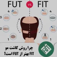 کاشت مو فقط با 17میلیون