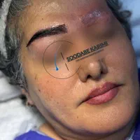 جشنواره ویژه مرکز کاشت ابرو