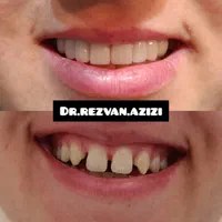 لمینت و کامپوزیت فوق حرفه ای در دندانپزشکی بینظیر|خدمات آرایشگری و زیبایی|شیراز, ملاصدرا|دیوار