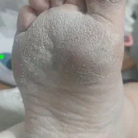 کفسابی درمانی فقط 450 در سالن زیبایی سمیرا محمدی