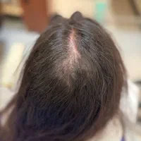 پی ار پی ،مزوتراپی،اگزوزوم ،بوتاکس صورت و زیر بغل|خدمات آرایشگری و زیبایی|تهران, اقدسیه|دیوار