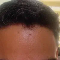 کاشت مو و ابرو نچرال