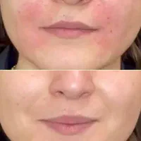 تزریق ژل و بوتاکس توسط پزشک لیزر موهای زاید|خدمات آرایشگری و زیبایی|تهران, هفت حوض|دیوار