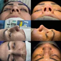 جشنواره ویژه جراحی بینی رینوپلاستی قیمت استثنایی|خدمات آرایشگری و زیبایی|جوانرود, |دیوار