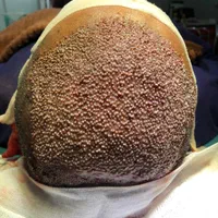 کاشت مو  و ابرو به روش سوپر fue پلاس(fue-sfue)|خدمات آرایشگری و زیبایی|شیراز, قدوسی غربی|دیوار