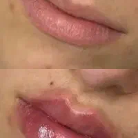 آموزش بوتاکس و فیلر