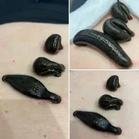 خدمات تخصصی زالو درمانی در مشکلات زنان