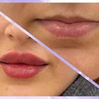 تزریق فیلر های با کیفیت و اصل توسط پزشک