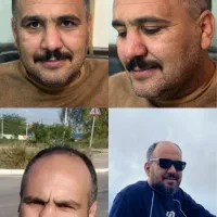 کاشت مو و ابرو با قیمتی باورنکردنی