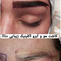 کاشت ابرو ۱۵میلیون وکاشت مو۲۰(جشنواره ۲۰روزه)