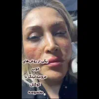 بوتاکس ژل مزوتراپی مو و صورت میکرونیدلینگ فشیال