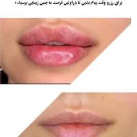 بوتاکس .فیلر‌‌.مزو صورت .مزوسر