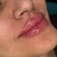 بوتاکس ژل لب