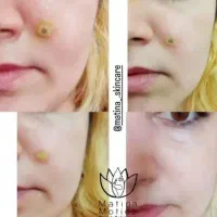 فیشال تخصصی، برداشت خال و ککو مک، ژل و بوتاکس|خدمات آرایشگری و زیبایی|شاهرود, |دیوار