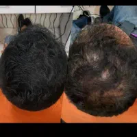 یکشنبه پی آر پی ومزو(بعدکاشت و درمان طاسی و ریزش)