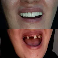 انجام لمینت متحرک دندان|خدمات آرایشگری و زیبایی|تهران, تهرانپارس غربی|دیوار