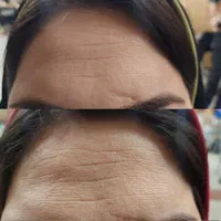 بوتاکس بدون تزریق