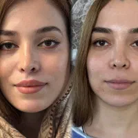 ژل لب کانتورینگ آنزیم ژل چانه مزوژل نخ لیفت صورت