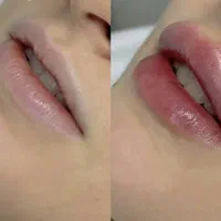 نیازمند مدل برای تزریق فیلر لب