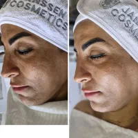 فیشال تخصصی ،پاکسازی پوست