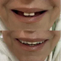 دندانساری متحرک(مصنوعی)|خدمات آرایشگری و زیبایی|اصفهان, جاوان|دیوار
