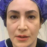 بایوفور صورت در کرج جوانسازی لیفت با بافت خودت