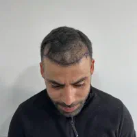 کاشت مو و ابرو