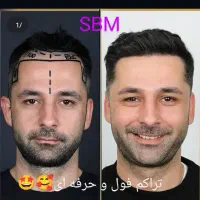 کاشت فوق حرفه/جدیدترین متدسوپرمیکروit+ مو/ابرو/ریش|خدمات آرایشگری و زیبایی|مشهد, هفت تیر (آب و برق)|دیوار