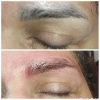 پاک کردن تتو(ریموو تتو)|خدمات آرایشگری و زیبایی|کرمانشاه, |دیوار