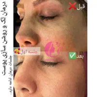 جشنواره پاییزمزوتراپی مزونیدلینگ و پی ارپی پوست مو|خدمات آرایشگری و زیبایی|اصفهان, دانشگاه اصفهان|دیوار