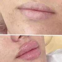 جشنواره تخفیف تزریق تخصصی ژل و بوتاکس|خدمات آرایشگری و زیبایی|شیراز, محراب|دیوار