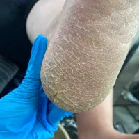 کف سابی پا و رفع ترک های عمیق پا