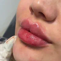 ژل و بوتاکس با قیمتی بسیار مناسب
