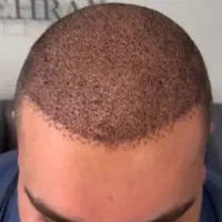 کاشت مو تخصصی ایلام