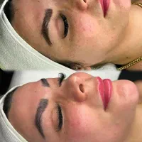 درمان لک صورت|آرایشی، بهداشتی، درمانی|اهواز, آریاشهر|دیوار