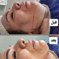 لیپو۴۵میلیون ابدو۶۵م باشرایط اقساط ساکشن غبغب۹۸۰۰