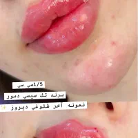 ژل وبوتاکس|خدمات آرایشگری و زیبایی|اهواز, کمپلو شمالی|دیوار