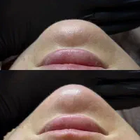 ژل لب فیلر بوتاکس پی ار پی فیلر گونه خط خنده|خدمات آرایشگری و زیبایی|کاشان, طالقانی|دیوار