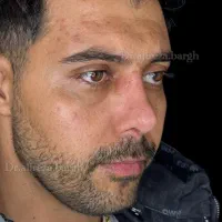 جشنواره تابستانه عمل جراحی بینی بدون تامپون/لیفت|خدمات زیبایی و سلامت|کرج, اصفهانیها|دیوار