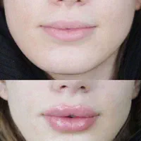 ژل بوتاکس مزوتراپی prp با قیمت استثنائی توسط پزشک|خدمات آرایشگری و زیبایی|اسلام‌شهر, باغ فیض|دیوار